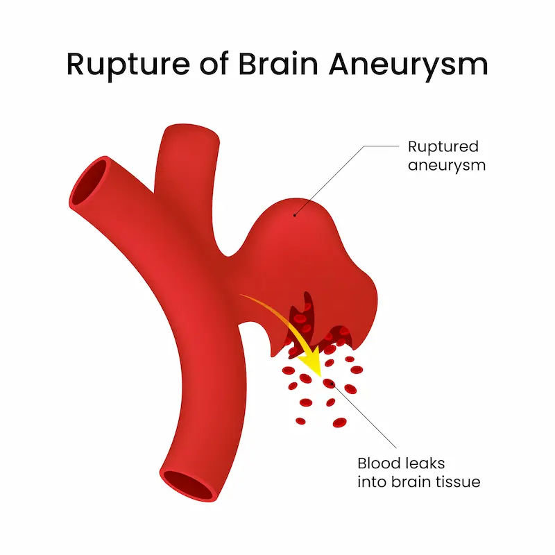 Cerebral Aneurysm Rupture Key Symptoms and Emergency Action